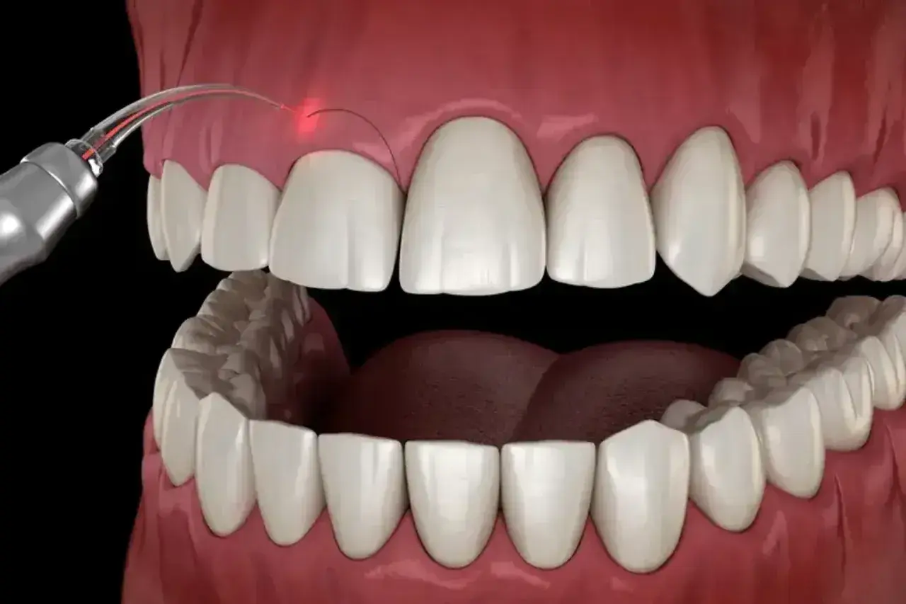 Zabieg gingiwektomii laserem. Czerwony promień lasera precyzyjnie modeluje dziąsło wokół białych zębów.