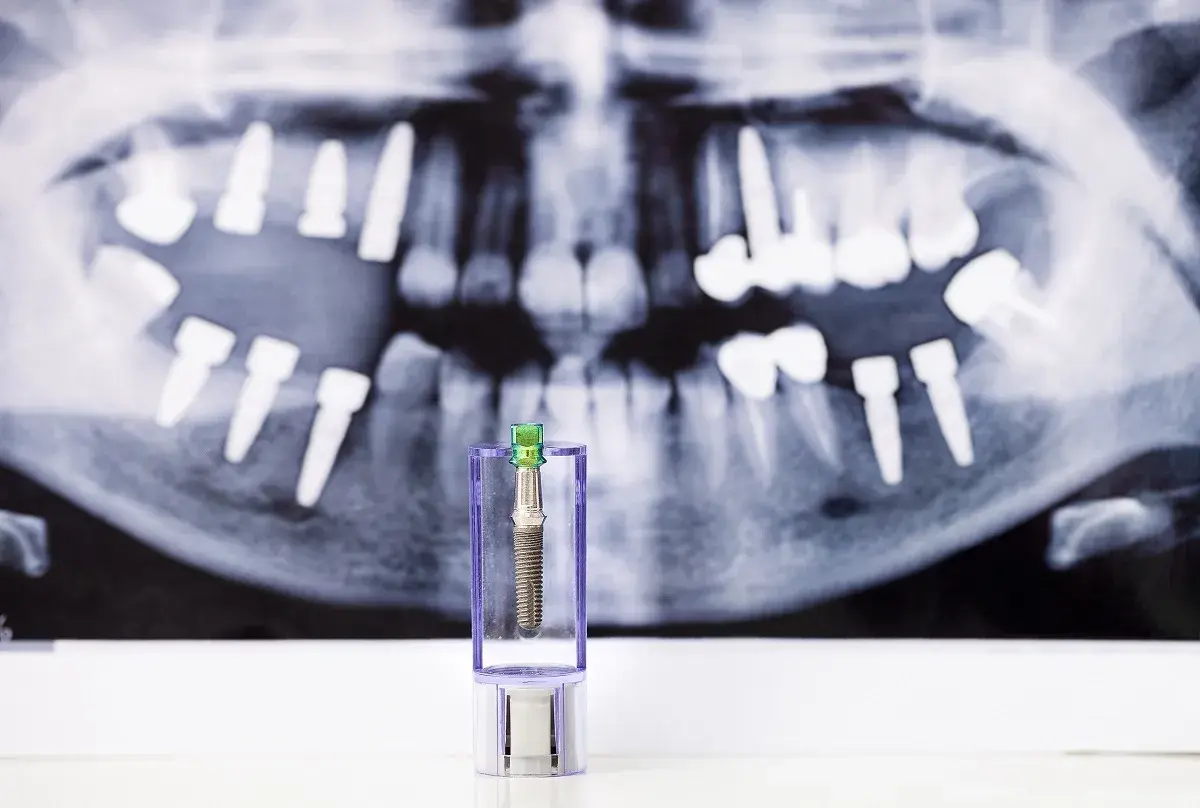 Implant dentystyczny w opakowaniu na tle zdjęcia rentgenowskiego szczęki z implantami. Obraz symbolizuje ryzyko odrzucenia przeszczepu kości pod implant.