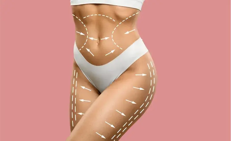 Co to liposukcja? Przewodnik po metodach, efektach i kosztach