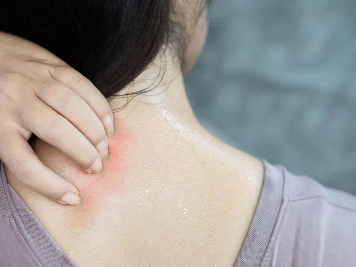 Mano che si gratta la nuca e il collo, con arrossamento e sudore. Un fastidioso prurito dietro la nuca e collo.