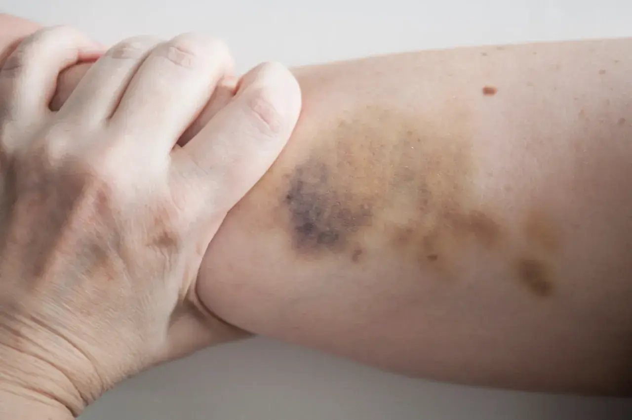 Eine Hand greift nach einem Bein mit dunklen Flecken, die auf einen Sturz oder Stoß hindeuten.