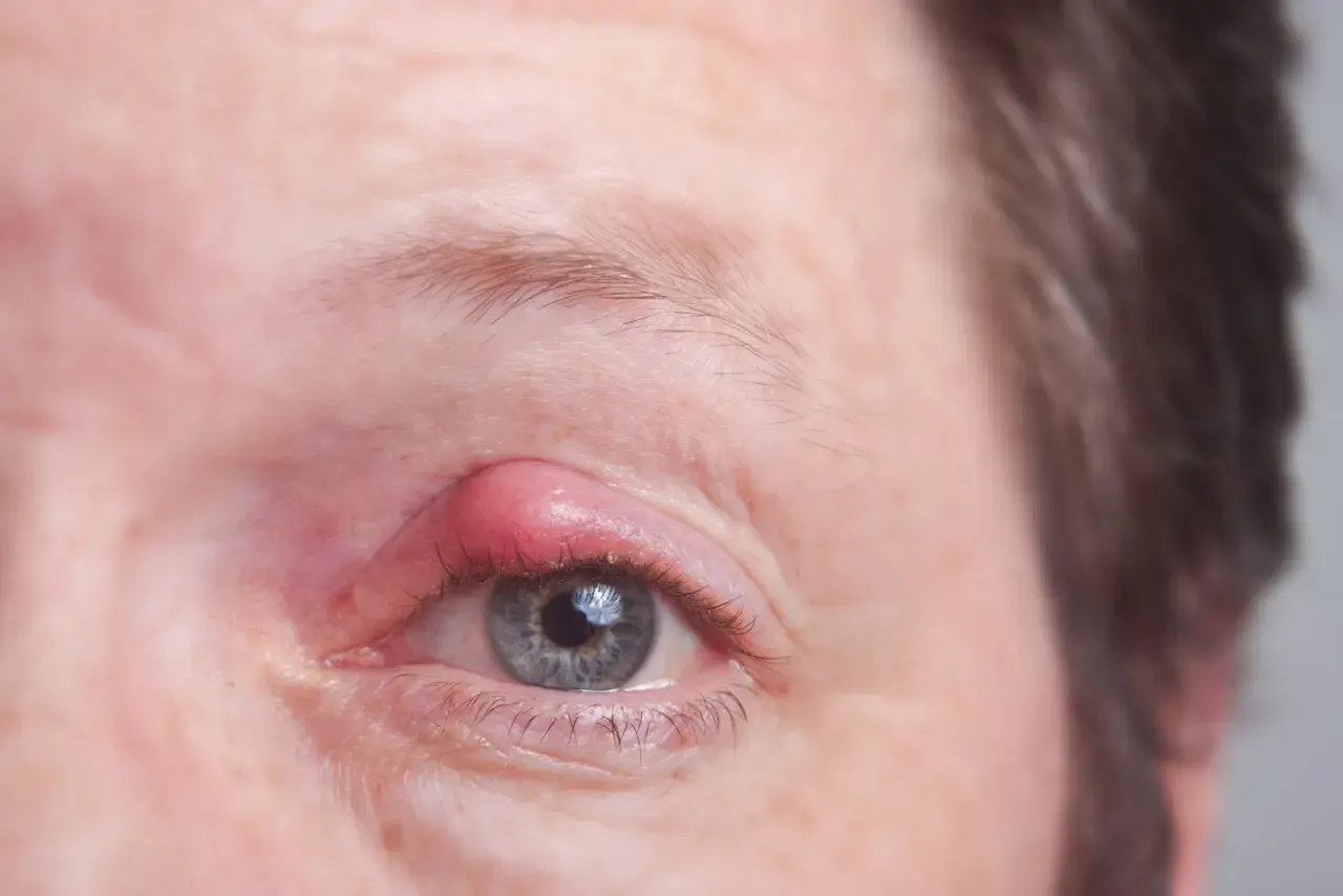 Ein roter, geschwollener Gerstenkorn am Augenlid. Dieses Gerstenkorn sieht ansteckend aus und verursacht Unbehagen.