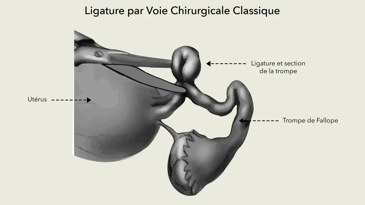 Illustration d'une ligature des trompes par voie chirurgicale classique, montrant l'utérus et une trompe de Fallope ligaturée et sectionnée.