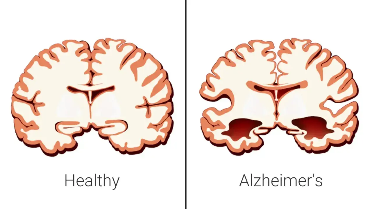 Porównanie mózgu zdrowego i z objawami choroby Alzheimera, która bywa nazywana cukrzycą typu 3. Widać zanik tkanki mózgowej.