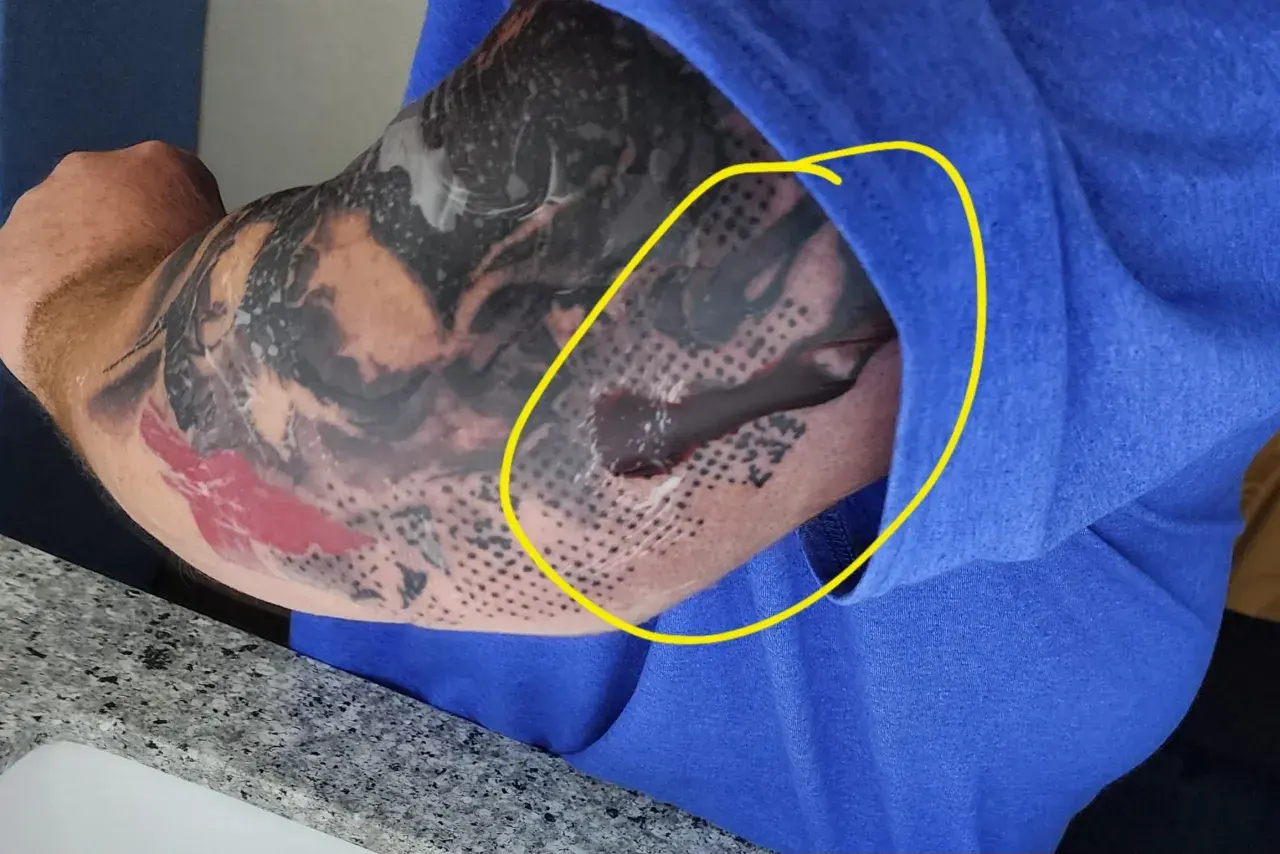Odparzenie po second skin na ręce z tatuażem. Widoczny płyn i zaczerwienienie pod folią.
