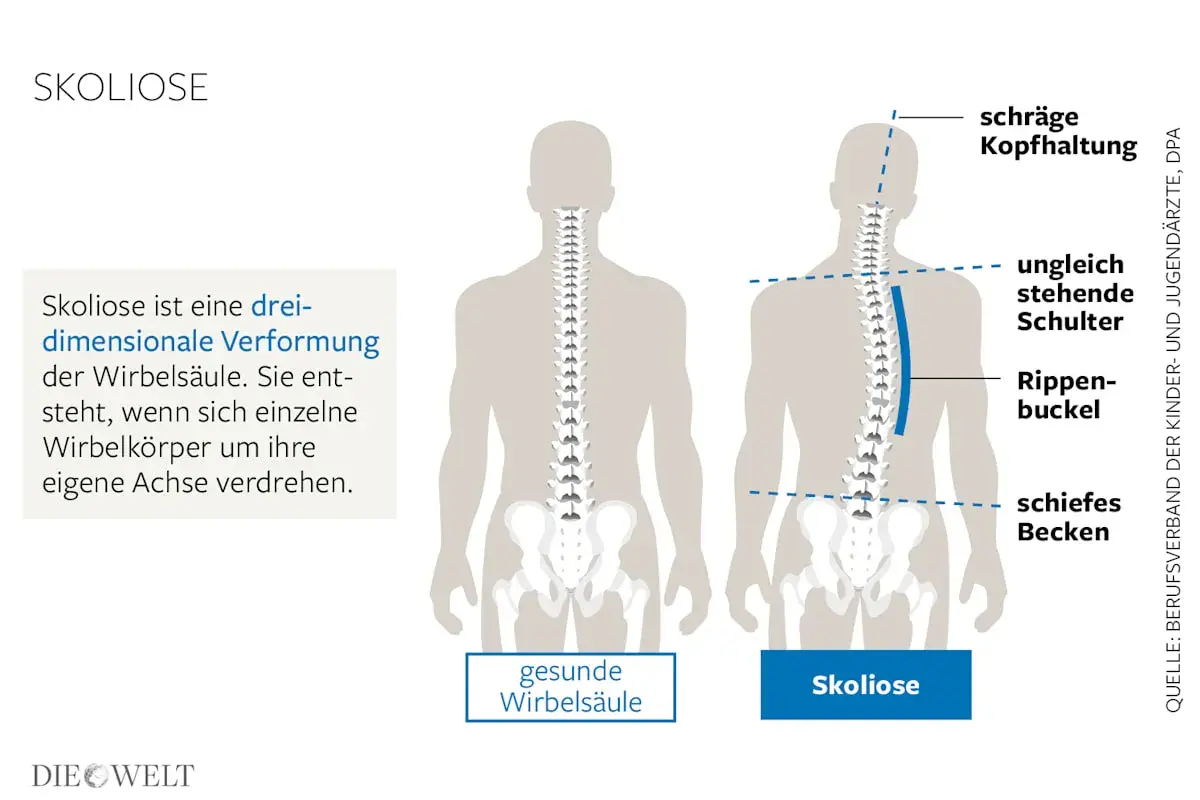 Vergleich einer gesunden Wirbelsäule mit einer Skoliose, die einen Rippenbuckel und schiefe Schultern verursacht.