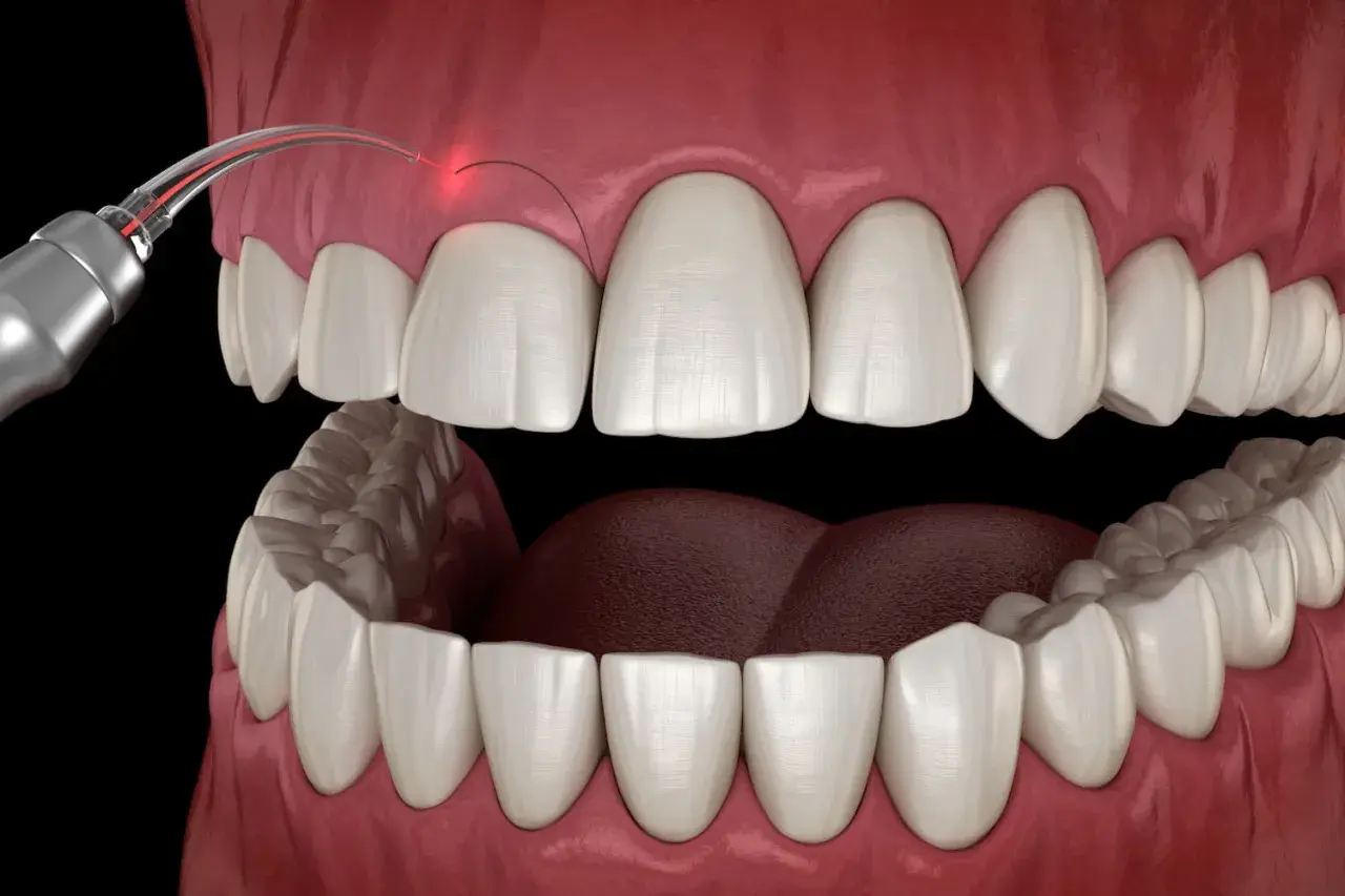 Zabieg gingiwektomii laserem: precyzyjne modelowanie dziąseł dla pięknego uśmiechu.