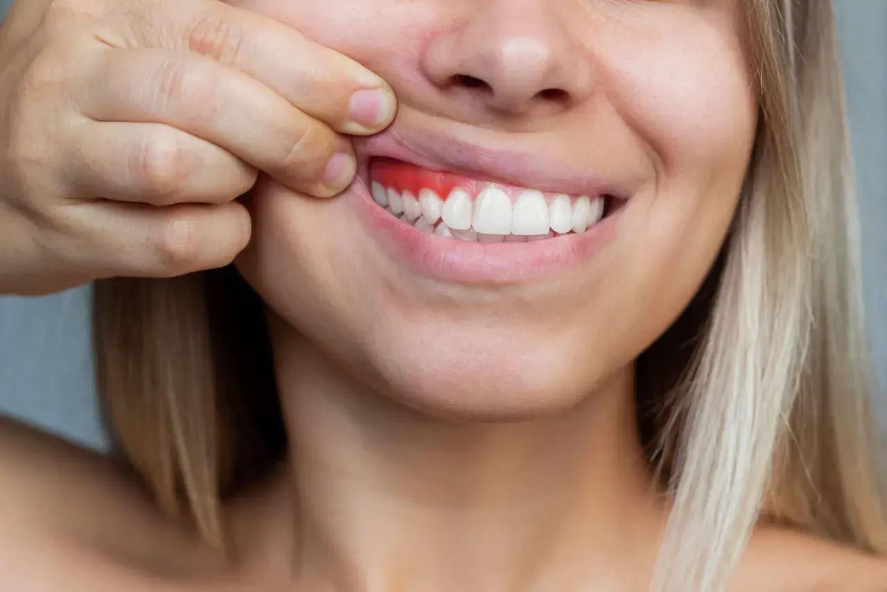 Una persona se tira del labio superior para mostrar sus encías, que están rojas e inflamadas, indicando la falta de encias sanas.