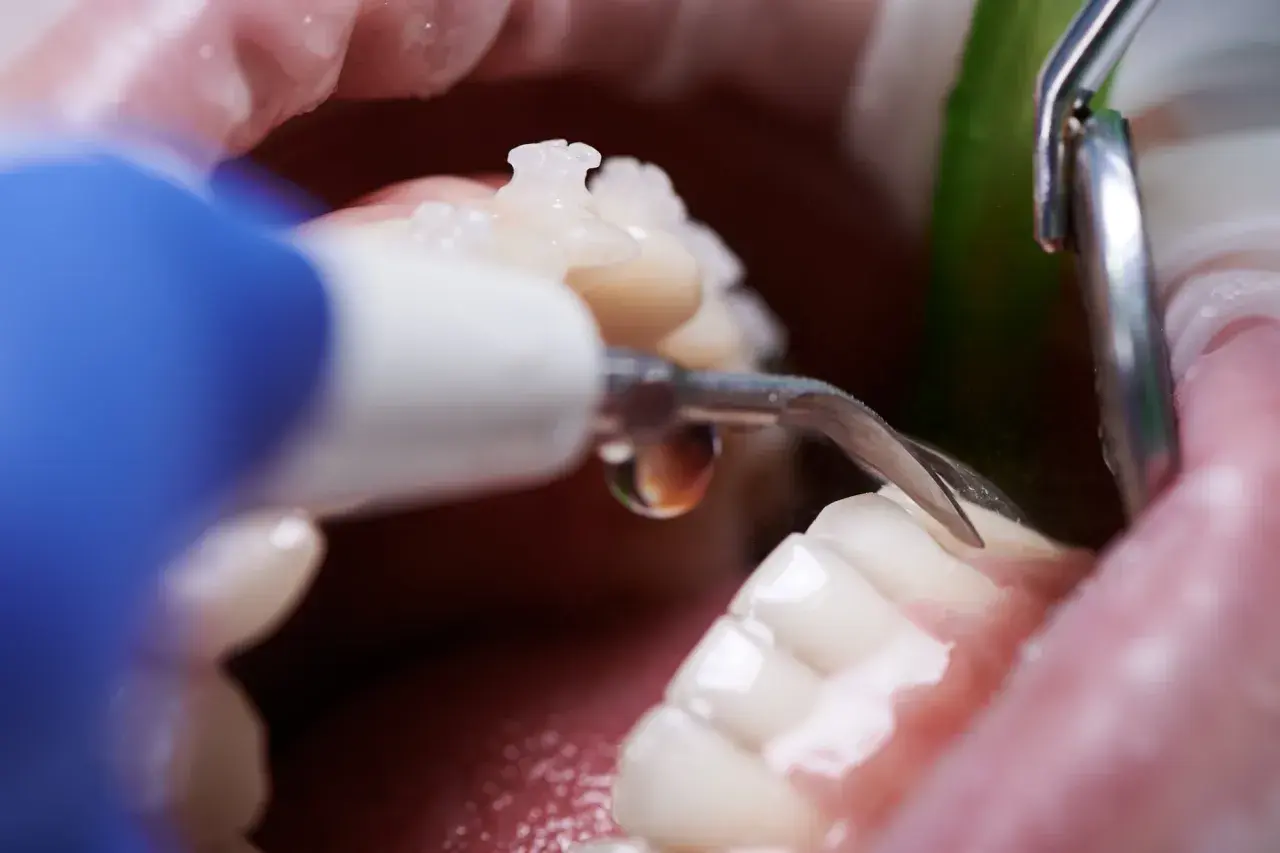Dettaglio di una pulizia denti professionale con strumento odontoiatrico.