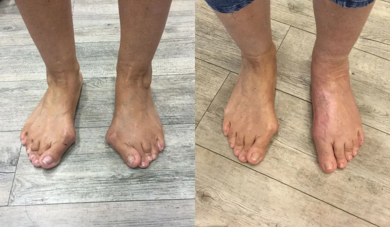 Vorher-Nachher-Vergleich von Füßen mit Hallux valgus, rechts nach Lapidus Arthrodese.