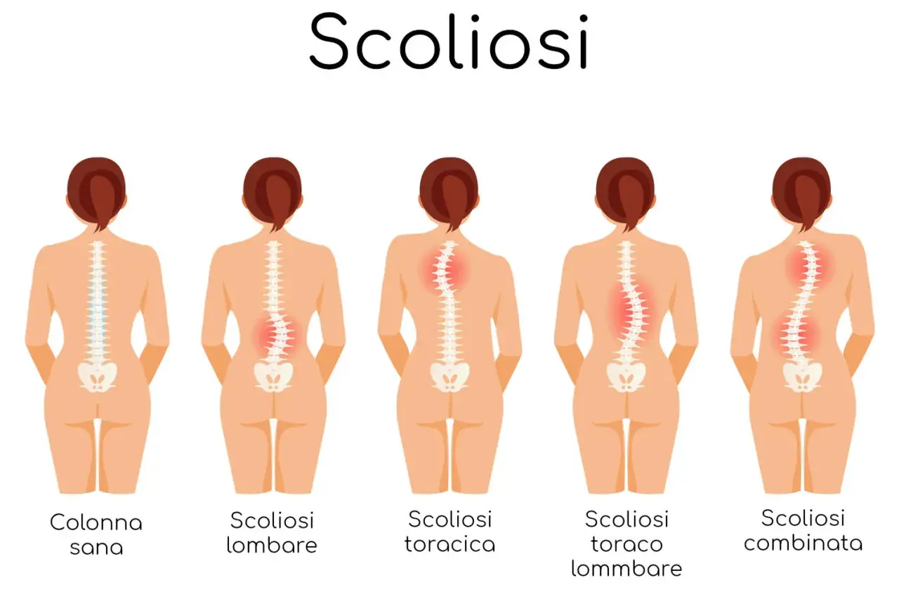 Illustrazione mostra diverse forme di scoliosi, inclusa la scoliosi lombare e toracica, evidenziando il gibbo.