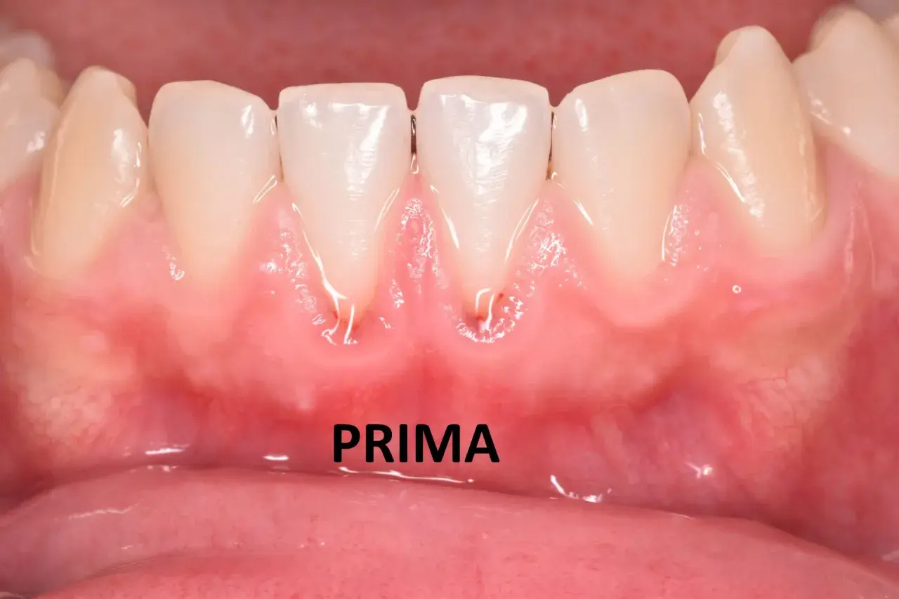 Gengive infiammate e arrossate intorno ai denti anteriori, con segni di recessione gengivale. La parola "PRIMA" indica la situazione iniziale.
