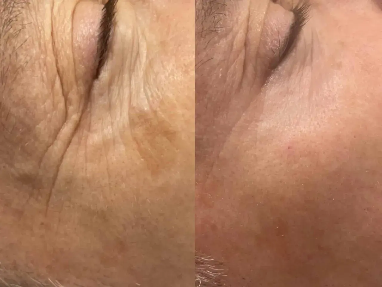 Split image showing before and after of skin treated with fractional CO2 laser, with reduced wrinkles.
