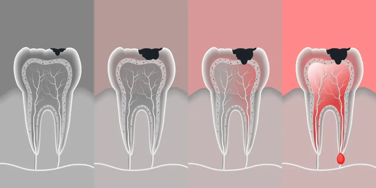 Ilustración muestra cómo es una caries dental, desde una pequeña mancha negra hasta una infección avanzada con pus.