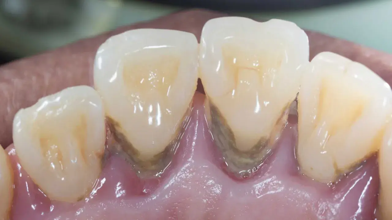 Denti con evidente accumulo di tartaro e infiammazione gengivale, segni di paradontosi dentale.