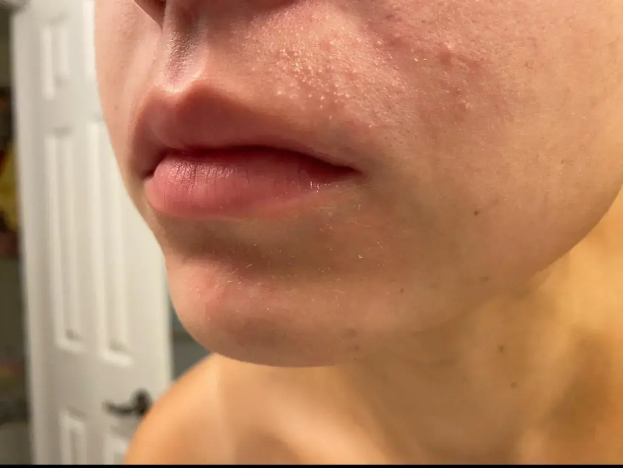 Närbild på mun och haka med rodnad och små utslag, tecken på elidel perioral dermatit.