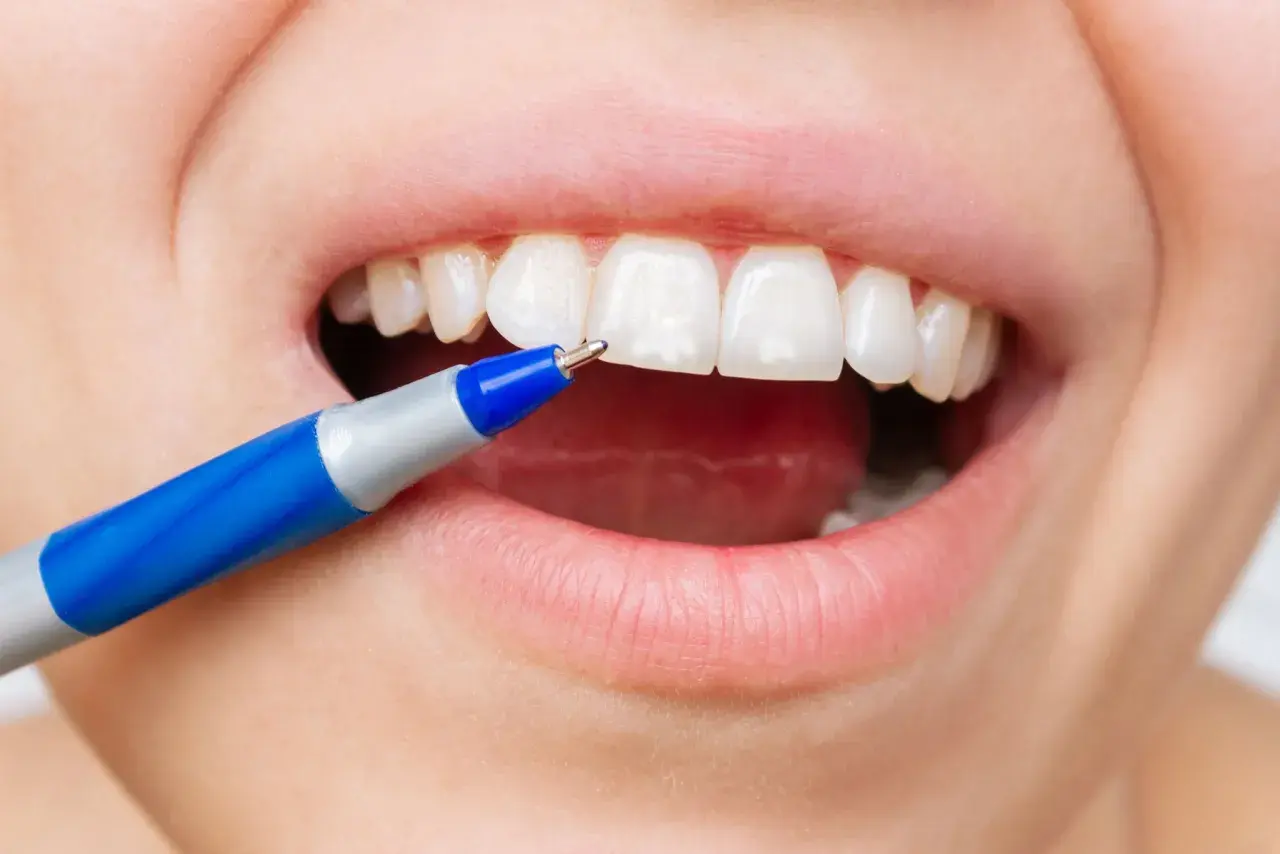Applicazione di fluoro sui denti con una penna speciale per una protezione duratura.