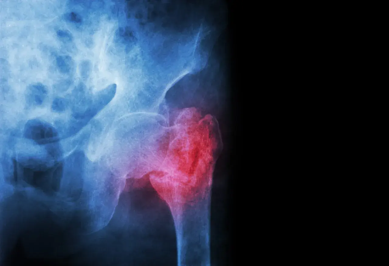 Radiographie du bassin montrant une fracture du col du fémur, marquée en rouge pour indiquer la douleur et la lésion.
