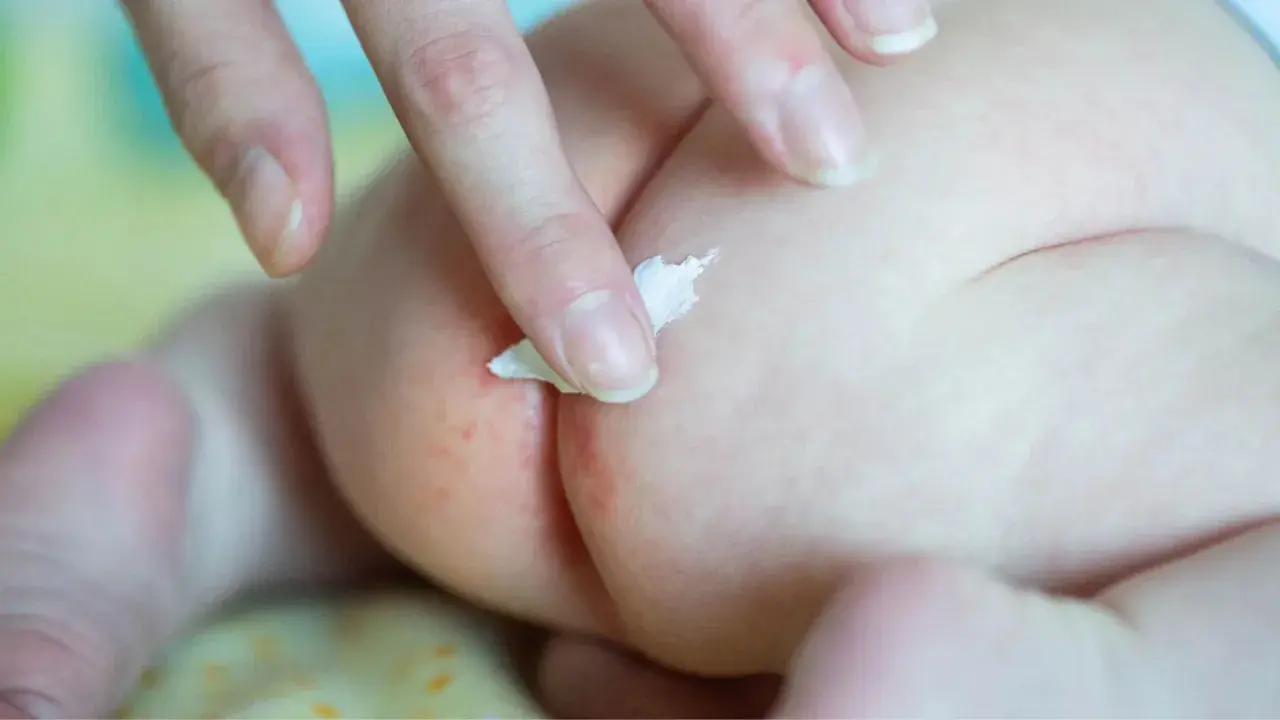 Mano applica crema su piaghe culetto neonato. Come curarla con delicatezza per lenire il rossore.
