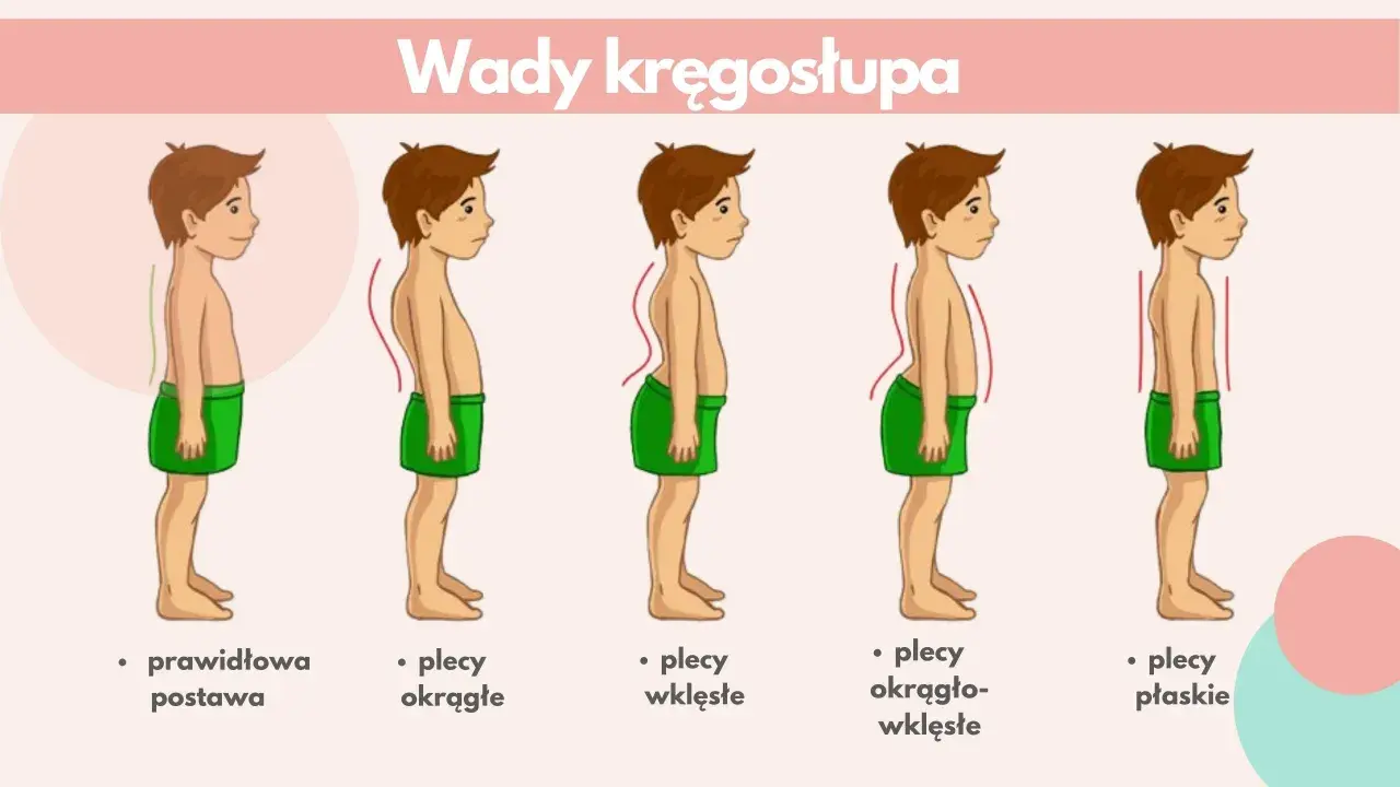 Ilustracja pokazuje wady kręgosłupa: plecy okrągłe, wklęsłe, okrągło-wklęsłe i płaskie. Lordoza to nadmierne wygięcie kręgosłupa.