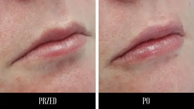 Kwas hialuronowy do ust: Jak wybrać idealny dla naturalnego wyglądu?
