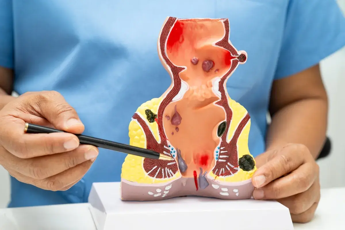 Modello anatomico che illustra emorroidi sanguinanti e altre patologie anali.
