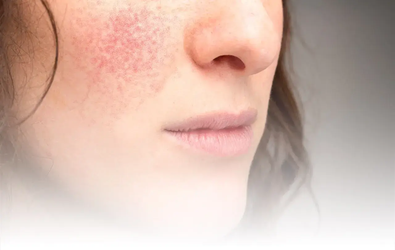 Närbild på en kvinna med rodnad på kinden, ett tecken på rosacea. Bilden visar hur man kan behandla rosacea.