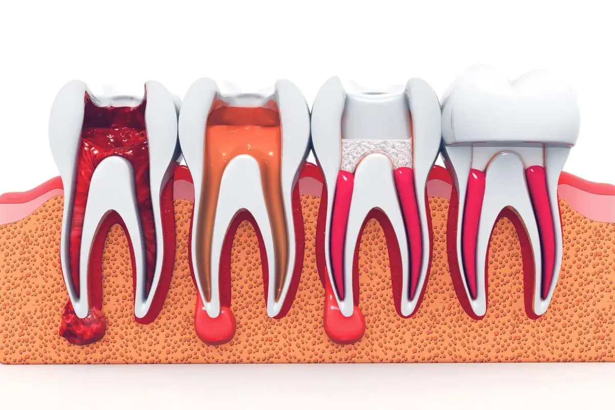 Ilustración de dientes con pulpectomia multirradicular, mostrando diferentes etapas de tratamiento endodóntico.