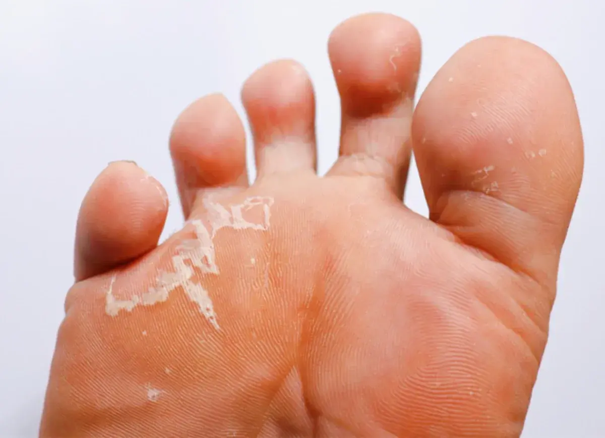 Le pied de l'athlète montre une peau qui pèle entre les orteils, signe d'une mycose.