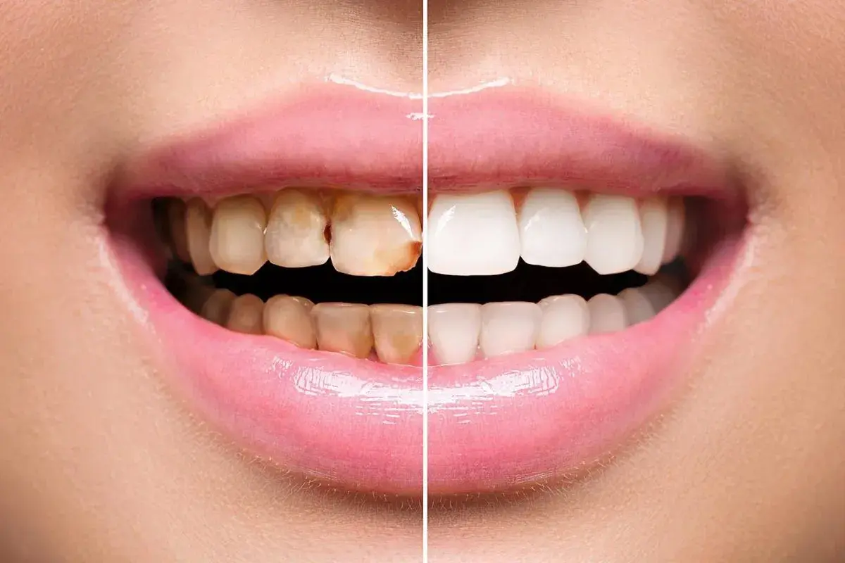 Sorriso diviso: da denti ingialliti e con placca a bianchi e splendenti.