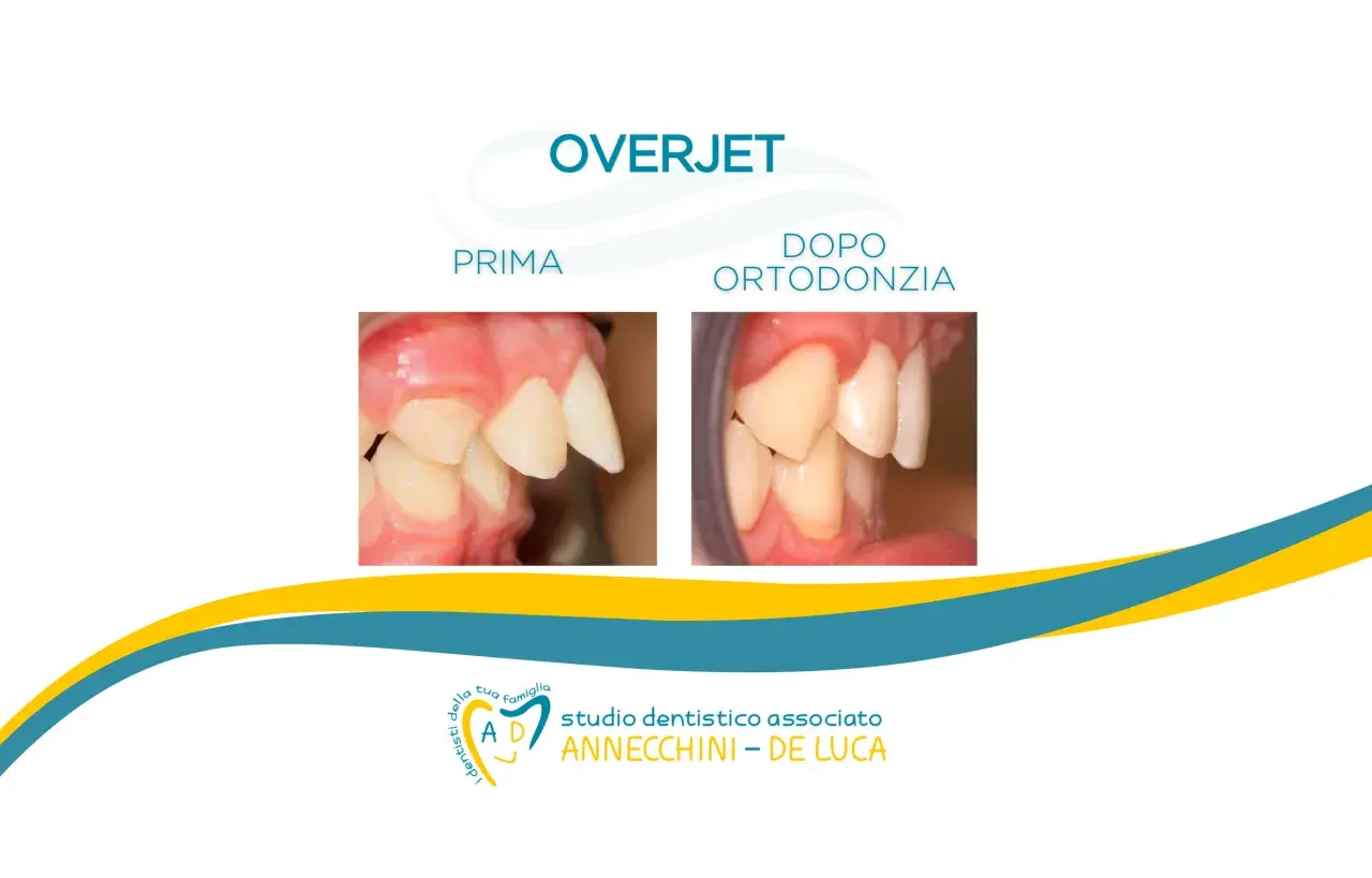 Prima e dopo ortodonzia: denti castoro corretti. Studio dentistico Annecchini - De Luca.