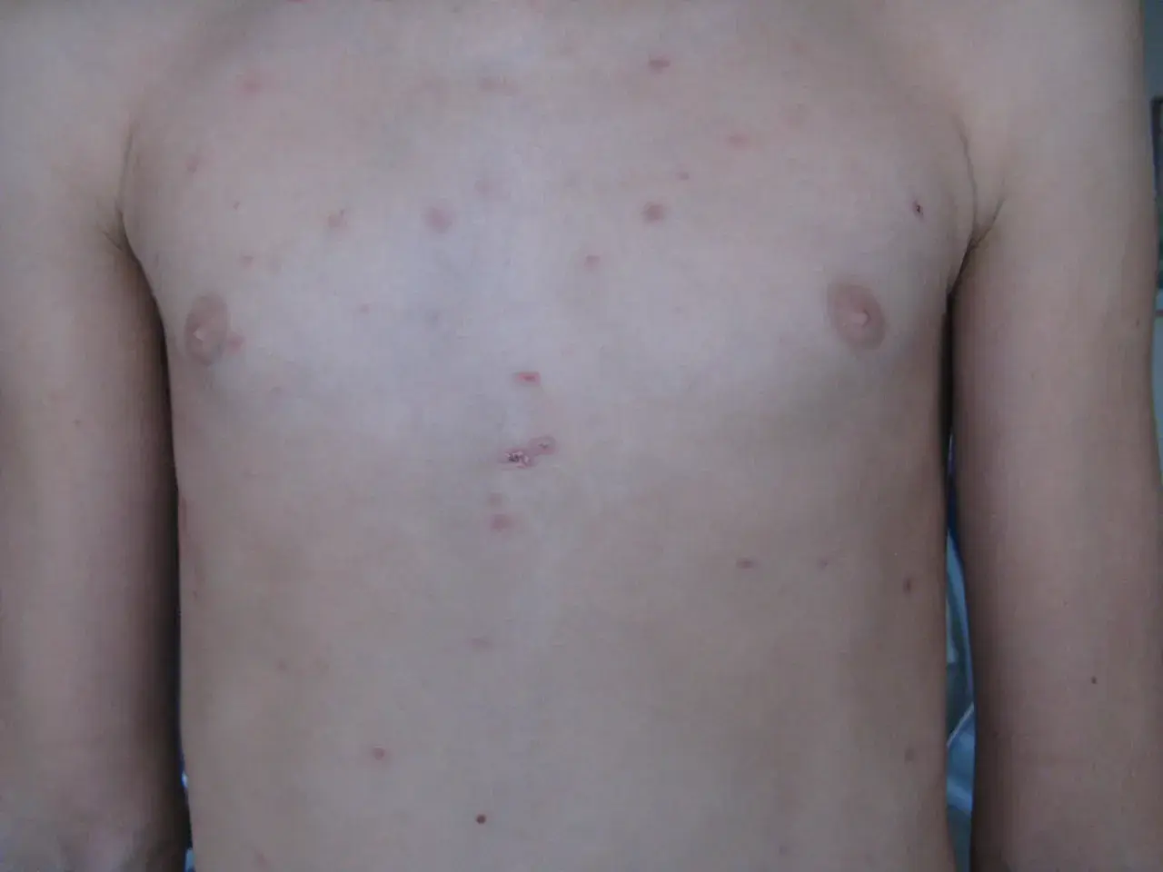 Torace con lesioni cutanee rosse e pruriginose, indicative di pitiriasi lichenoide cronica.
