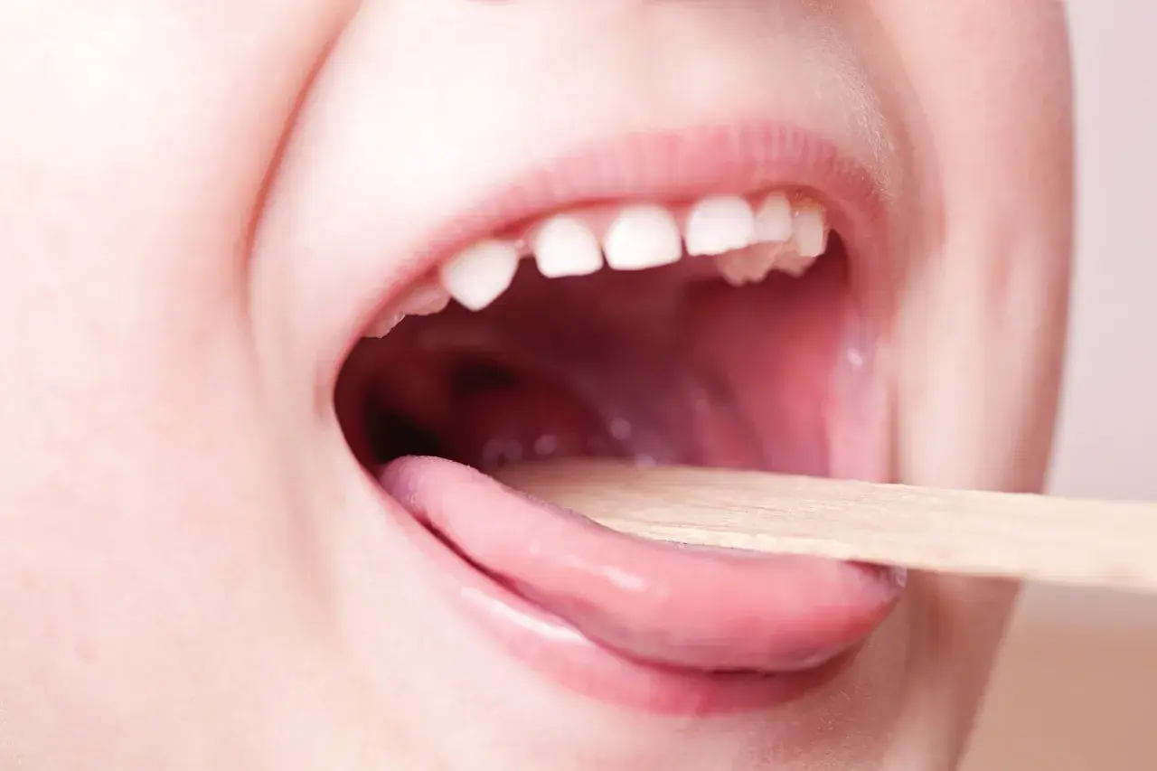 Bocca di bambino aperta con linguetta di legno per controllare la gola. Informazioni sulla faringite bambini quanto dura.