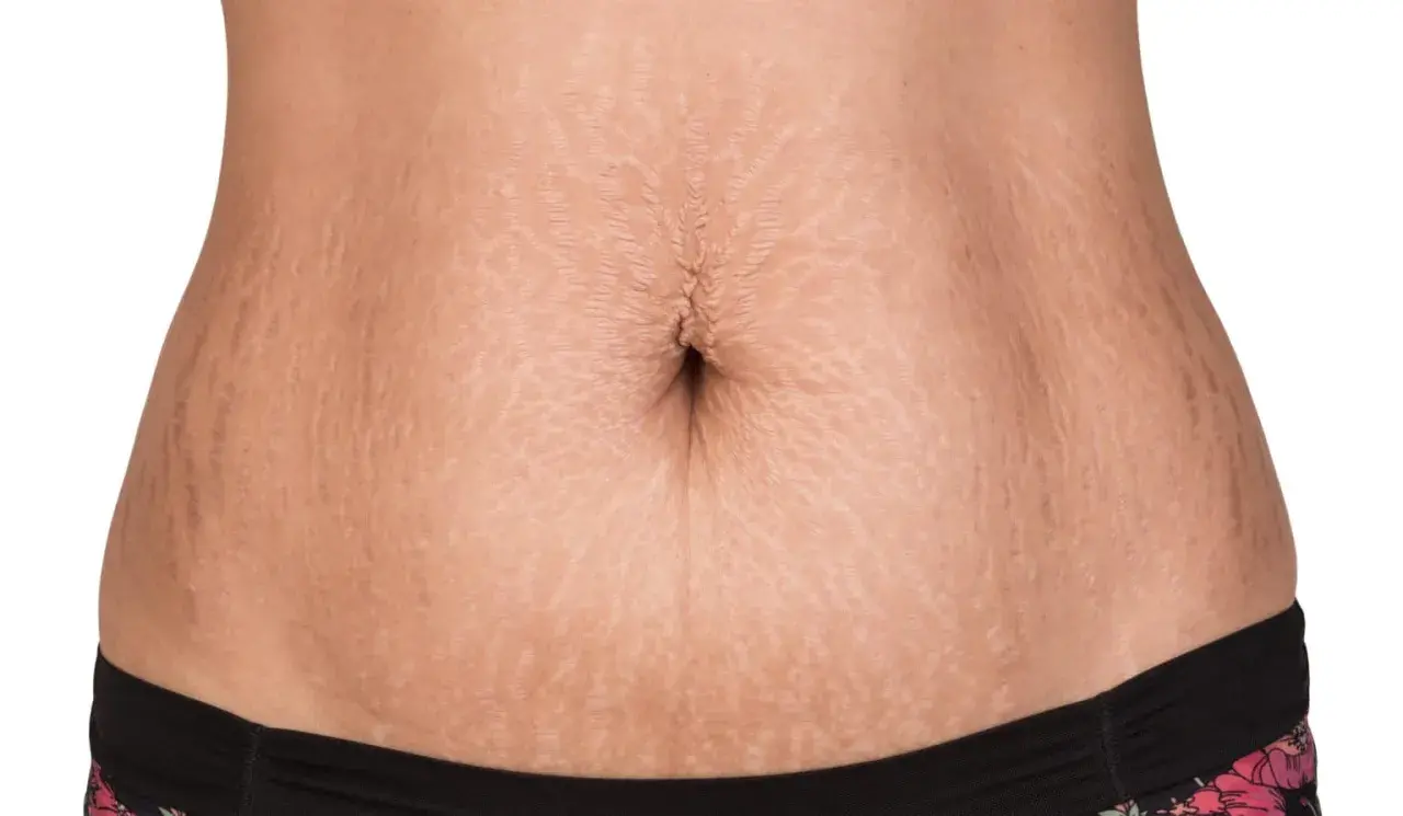 En mage med bristningar, en vanlig syn efter graviditet. Många väljer en mommy makeover för att återfå sin kropp.