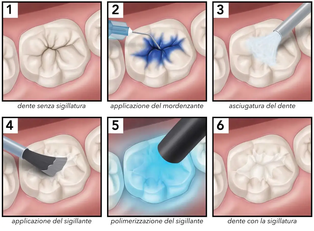 Illustrazione dei passaggi per sigillare i solchi dei denti, dalla preparazione all'applicazione del sigillante.
