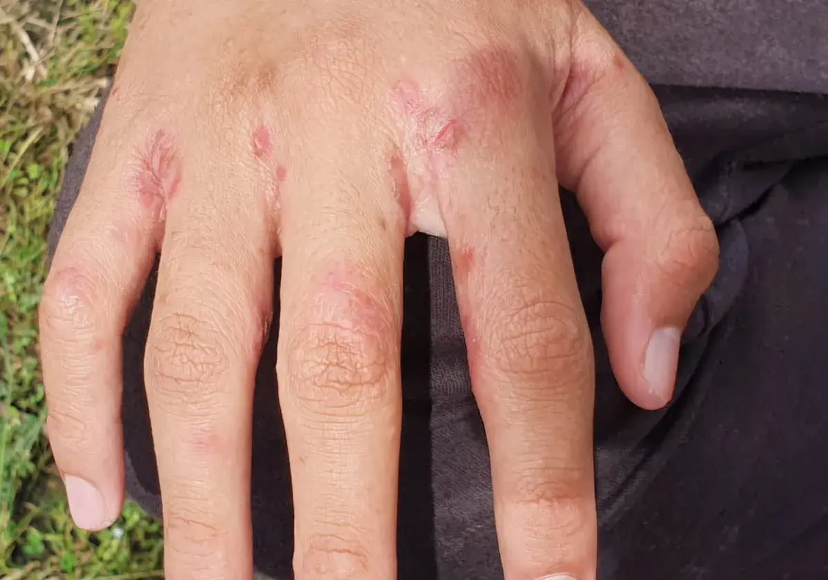 Här ser du hur skabb utslag kan se ut på händerna: små röda prickar och irriterad hud mellan fingrarna.