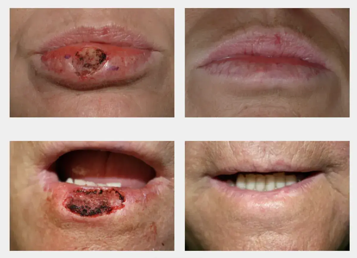 Cuatro imágenes muestran la evolución de un bulto en el labio, desde una lesión hasta la curación.