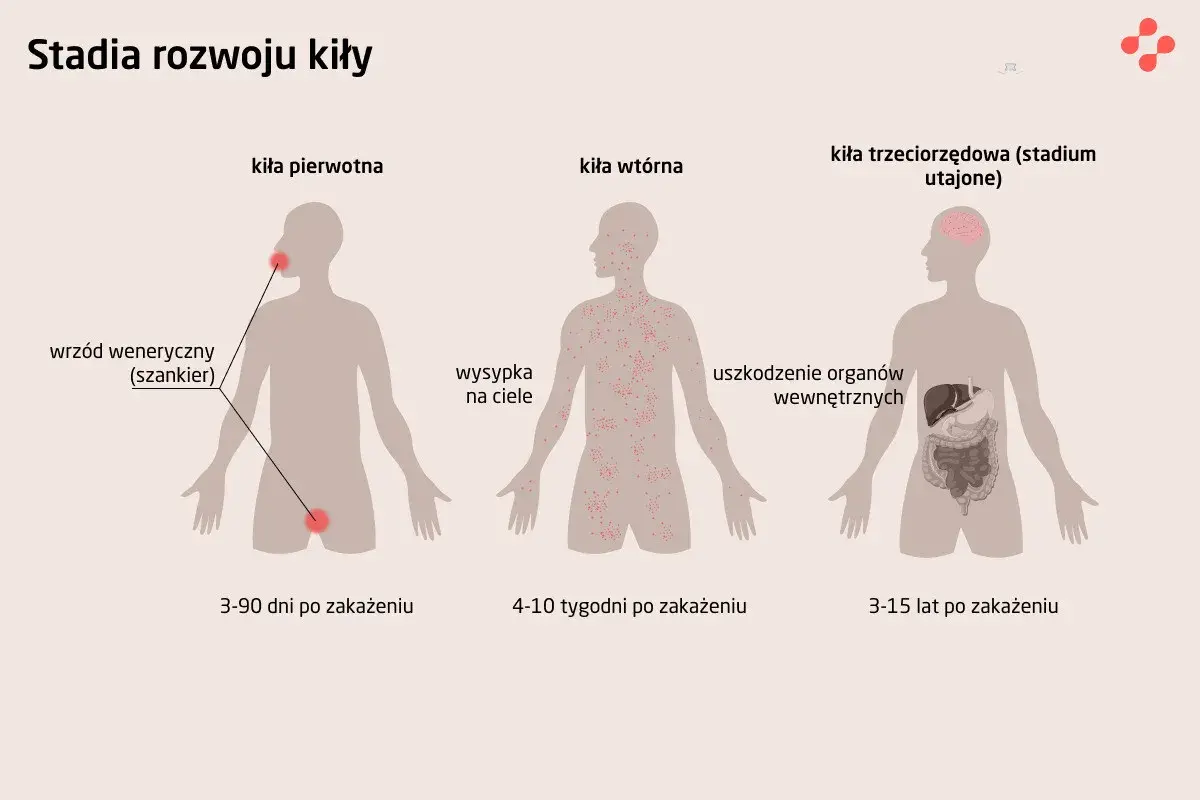Ilustracja przedstawia stadia rozwoju kiły: pierwotna (wrzód), wtórna (wysypka) i trzeciorzędowa (uszkodzenie organów).