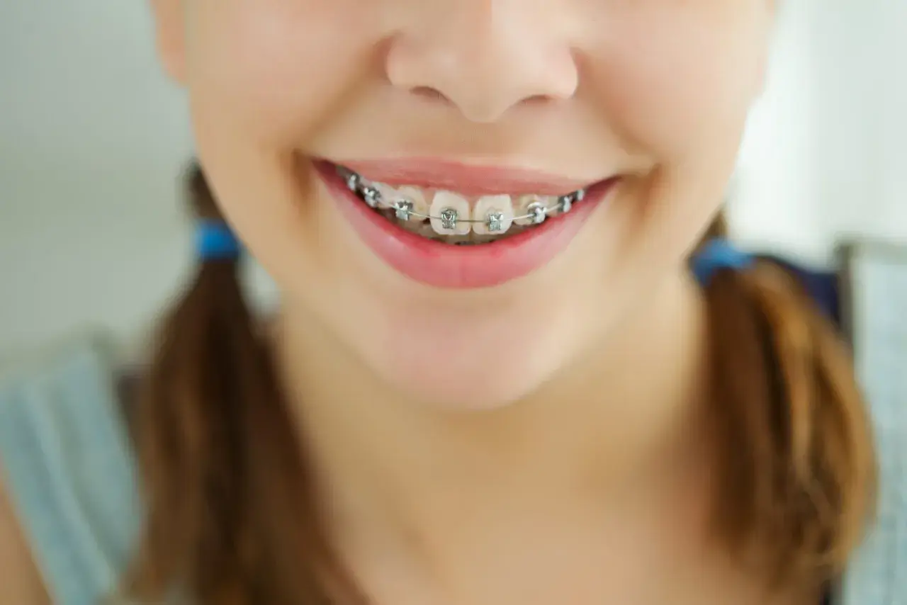 Sorriso di bambina con apparecchio ortodontico, un percorso verso un sorriso perfetto, con afte frequentissime.