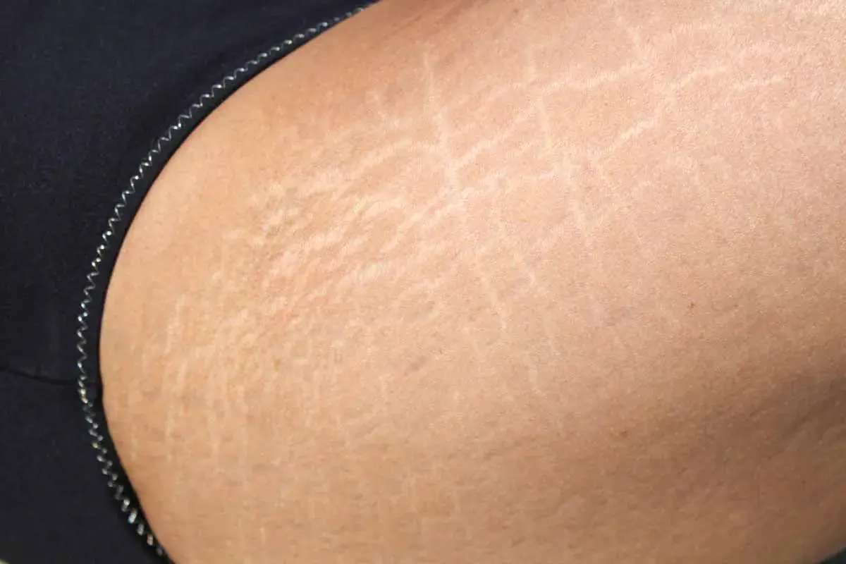 Dettaglio della pelle con smagliature sul bicipite, evidenziate da linee chiare e sottili.