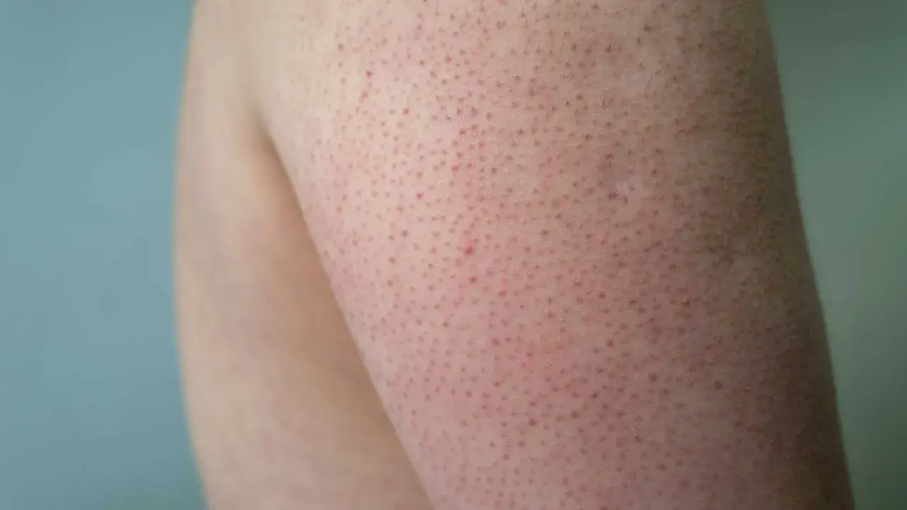 Närbild på hud med små röda prickar, typiskt för keratosis pilaris hos barn.