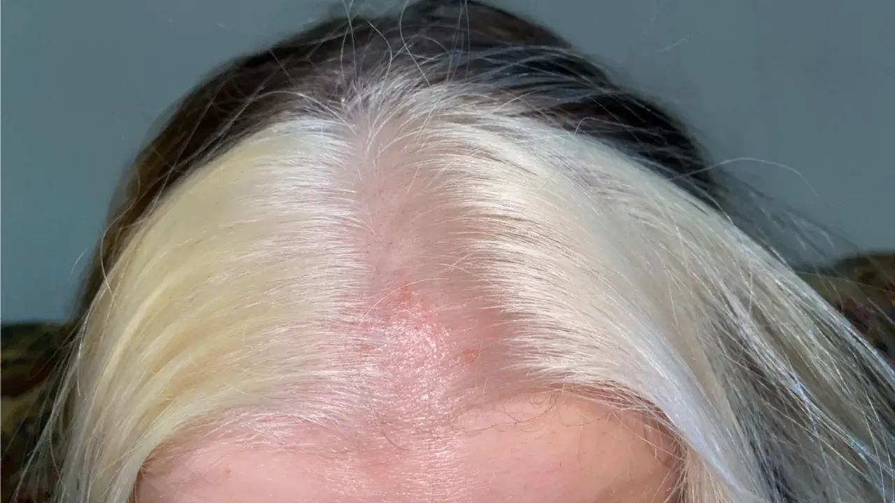 Cuero cabelludo enrojecido y con irritación, con mechones de cabello oscuro y rubio. Busca cómo curar quemaduras en el cuero cabelludo por decoloración.