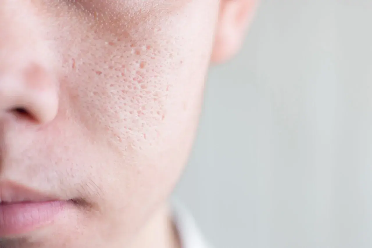 Primo piano della pelle di un uomo, mostrando cosa sono i pori dilatati e cicatrici da acne.