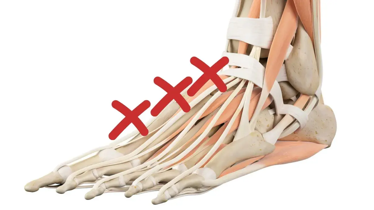 Anatomia del piede con tre croci rosse che indicano il **dolore piede sopra**. Muscoli e tendini evidenziati.
