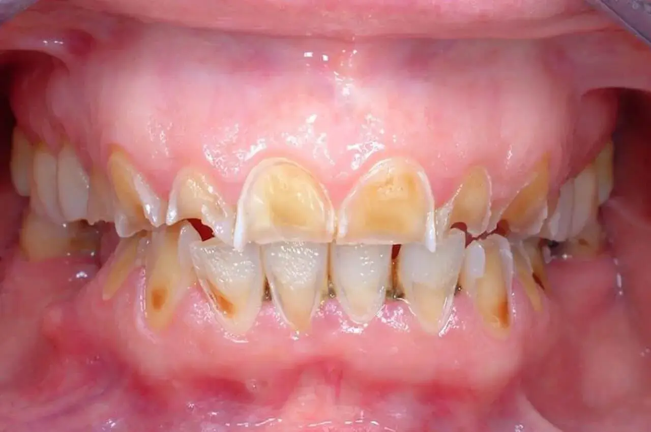 Denti ingialliti e consumati, con smalto eroso, un segno visibile degli effetti dell'anoressia sulla salute orale.