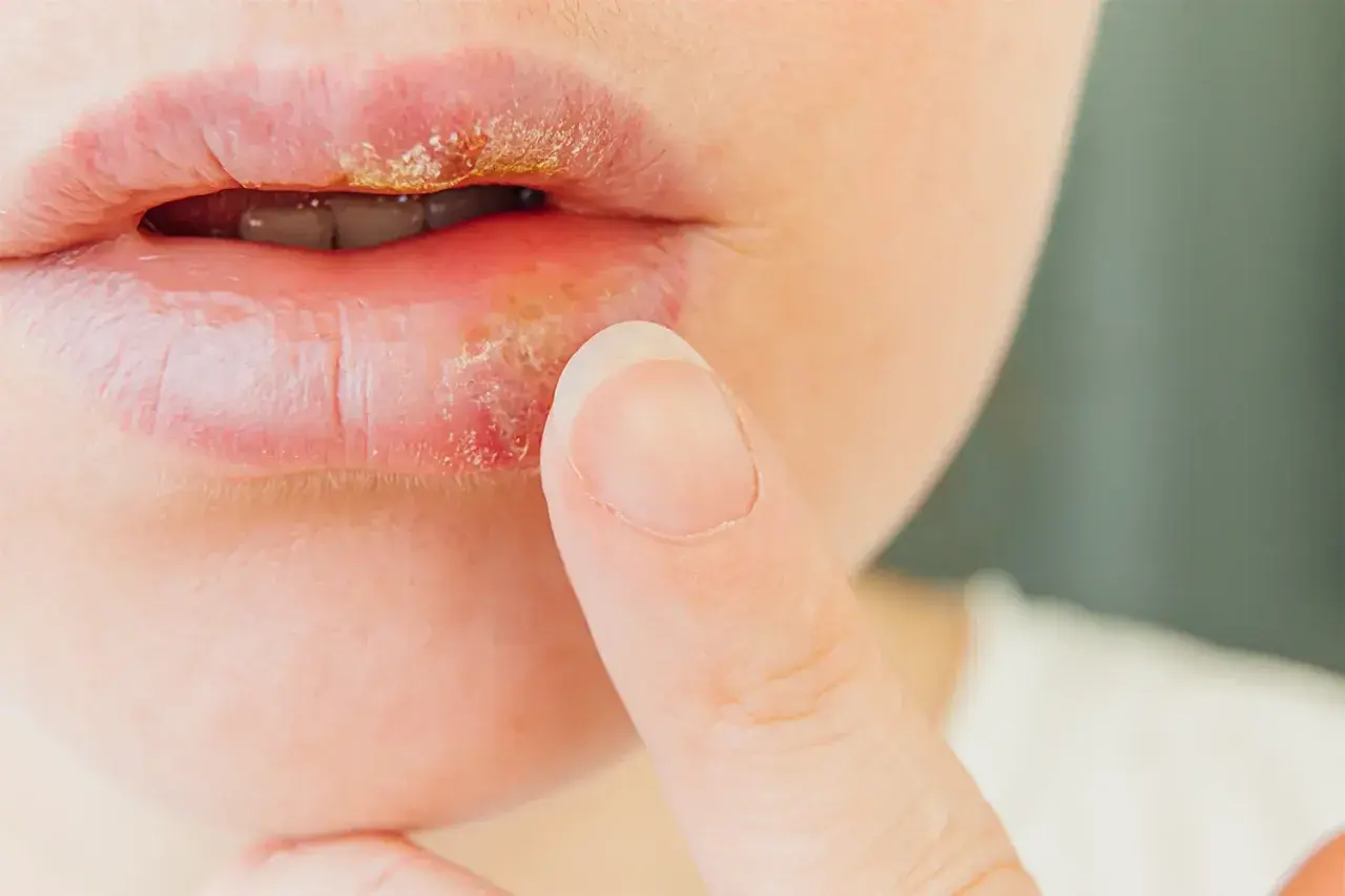 Labios con herpes labial, mostrando costras amarillentas y enrojecimiento. Un dedo se acerca a la zona afectada.