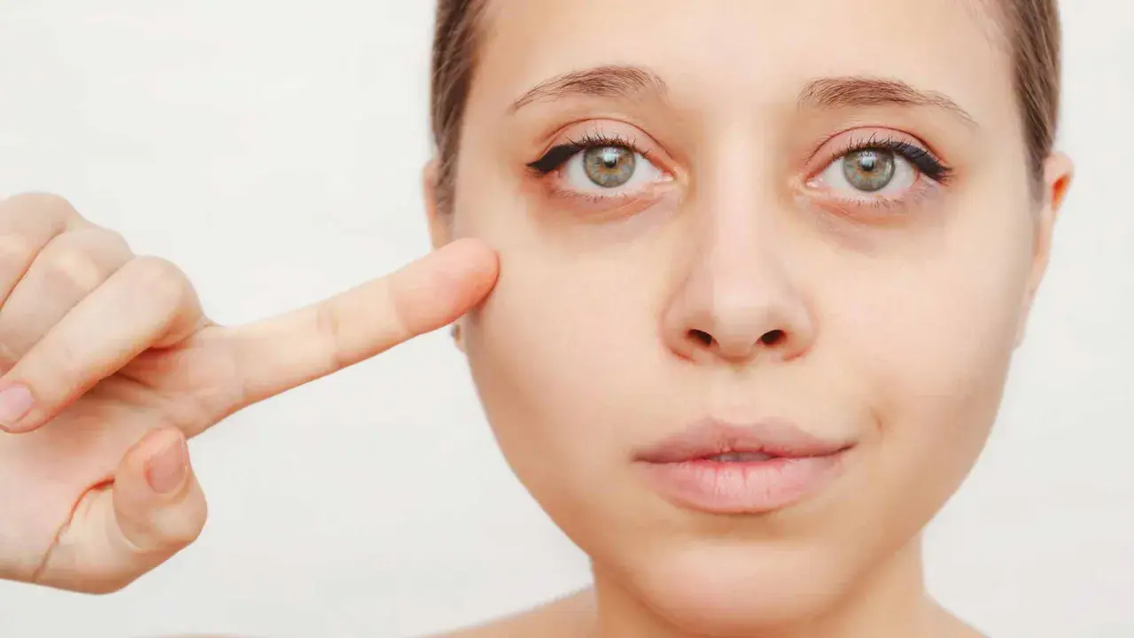 Primer dedo señala la zona debajo del ojo, mostrando ojeras vasculares.