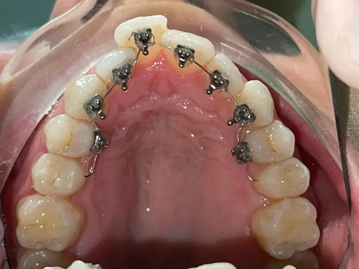 Dettaglio di un apparecchio linguale applicato ai denti superiori, quasi invisibile dall'esterno.