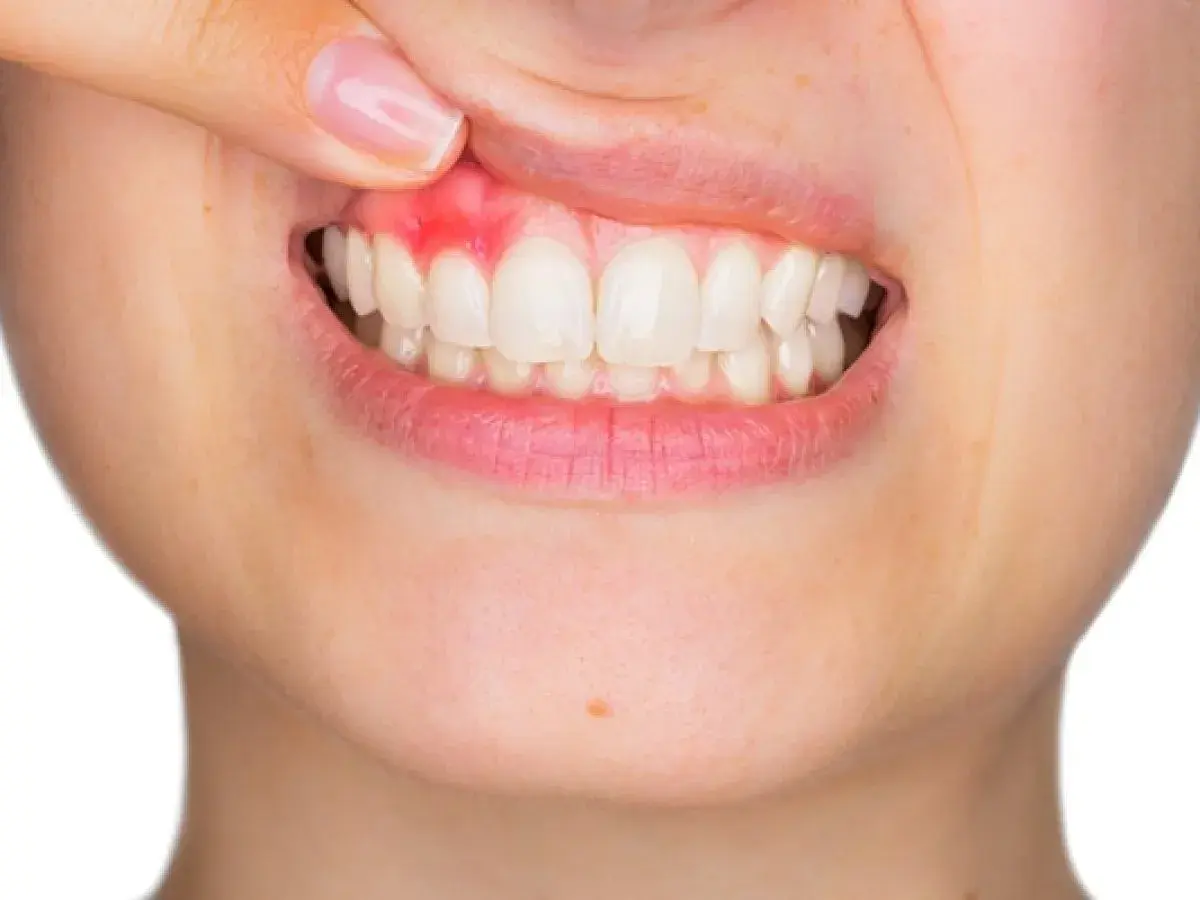 Encía inflamada y enrojecida, señal de periodontitis severa.