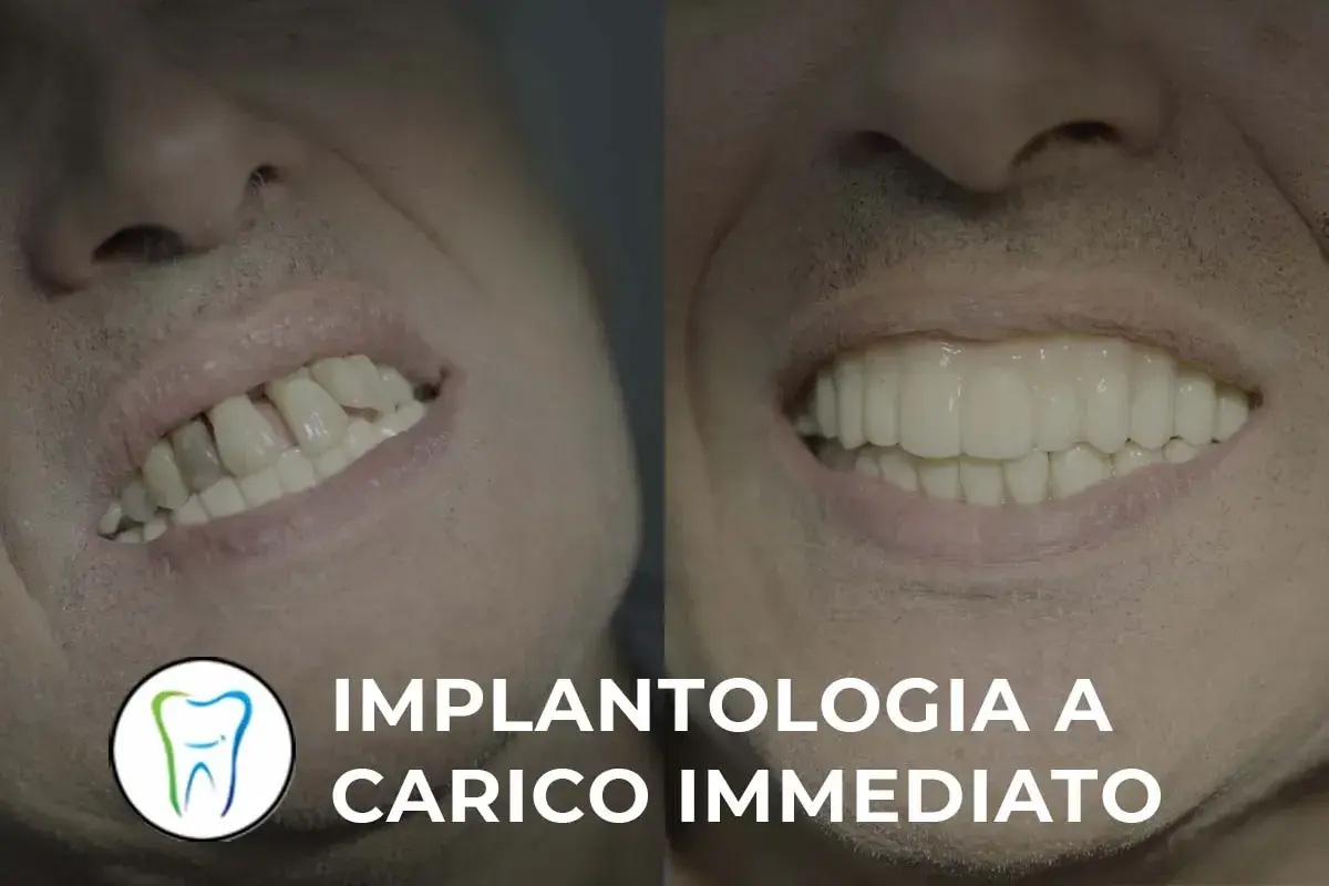 Prima e dopo: sorriso trasformato con implantologia a carico immediato. Valuta le controindicazioni per un risultato perfetto.